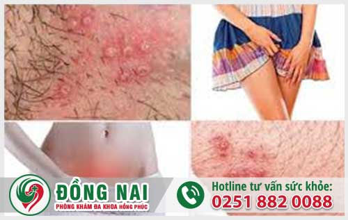 Nổi mụn ở vùng kín triệu chứng không nên bỏ qua